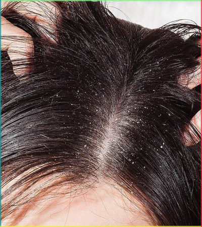 DANDRUFF